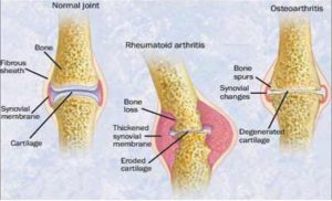 arthritis treatment - acupuncture